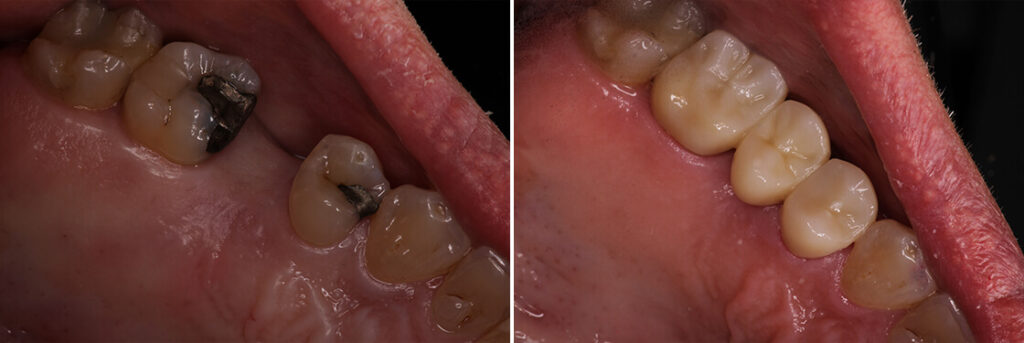 Bridges: Before & After