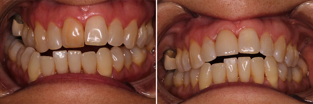 Crowns: Before & After