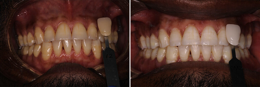 Whitening: Before & After