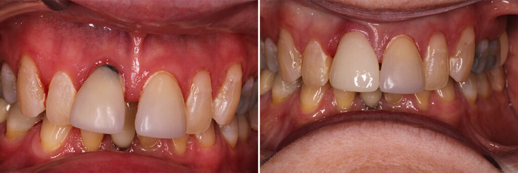 Veneers: Before & After