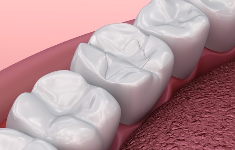 illustration of a dental filling